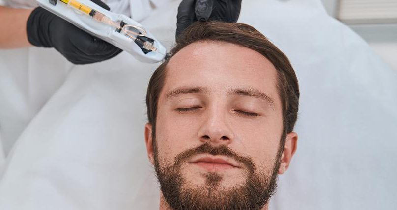 Hair Loss Treatment mesotherapy microneedling