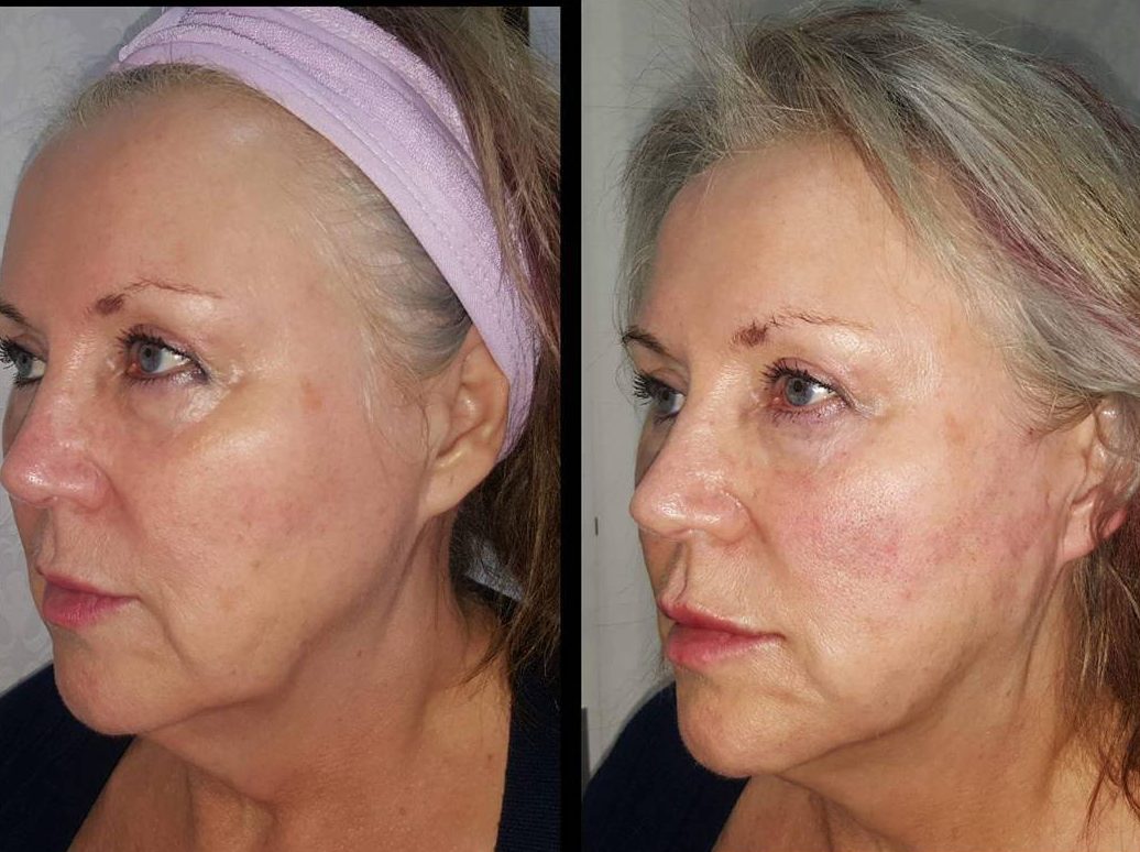 NewLife Aesthetics Clinic Thread lift treatment Nonsurgical face lift