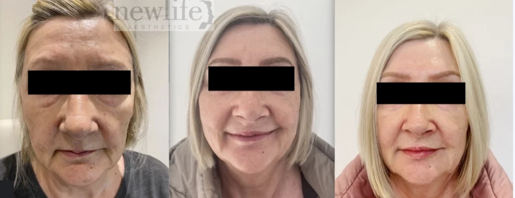 Before & After results